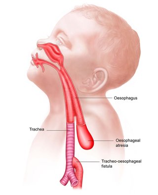 Annotated diagram of the head and shoulders of a young boy showing oesophageal atresia and a tracheo-oesophageal fistula.